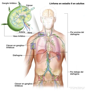 Linfoma en estadio II en adultos. En el dibujo se observa cáncer en 2 grupos de ganglios linfáticos por encima del diafragma y en 2 grupos de ganglios linfáticos por debajo del diafragma. También se muestra el diafragma. En una ampliación, se observan un ganglio linfático con células cancerosas, un vaso linfático, una arteria y una vena.
