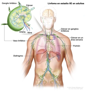 Linfoma en estadio IIE en adultos. En el dibujo se muestra cáncer que se diseminó desde un grupo de ganglios linfáticos hasta un área cercana en el centro del tórax. También se muestran un pulmón y el diafragma. En una ampliación, se observan un ganglio linfático con células cancerosas, un vaso linfático, una arteria y una vena.