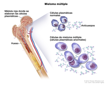 Mieloma múltiple; en la ilustración, se muestran células plasmáticas normales, células de mieloma múltiple (células plasmáticas anormales) y anticuerpos. También se muestra la médula roja en el hueso, en donde se elaboran las células plasmáticas.