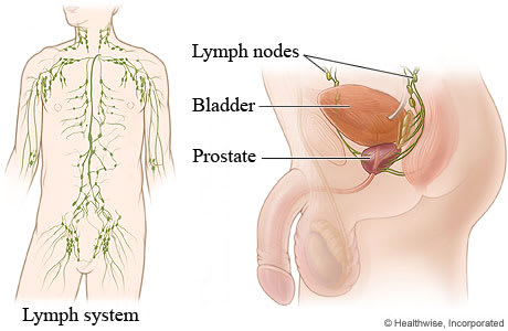 Lymph system throughout male body, with detail showing lymph nodes near bladder and prostate.