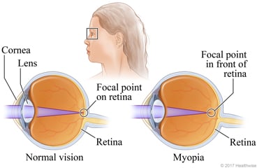 Cross-sections of eye with normal vision and eye with myopia