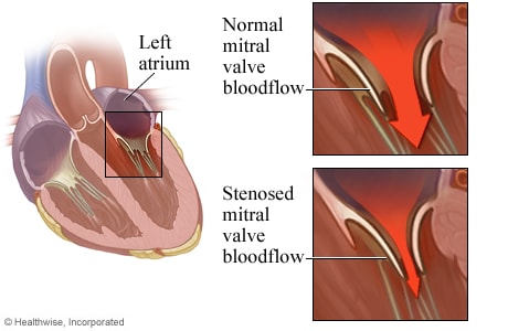 Location of mitral valve in heart, with detail of healthy mitral valve and one with stenosis