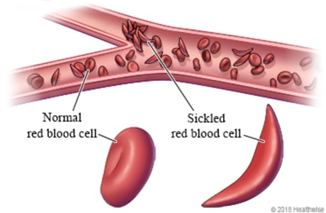 Inside view of red blood cells in blood vessel, with close-up of normal and sickled red blood cells