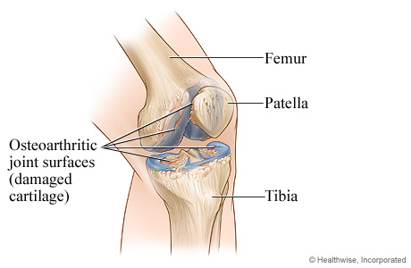 Osteoarthritis of the knee