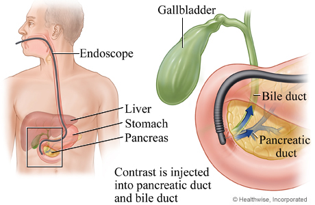 Placement of an endoscope during ERCP