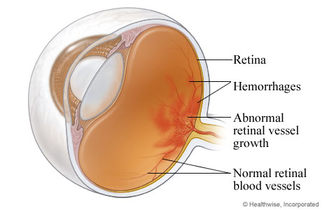 Diabetic retinopathy