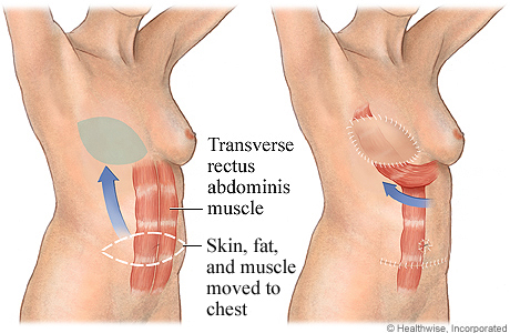 TRAM flap for breast reconstruction