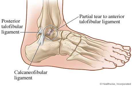 Ankle with a ligament tear