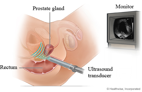 Transrectal ultrasound