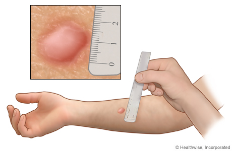 Measuring a tuberculin skin test reaction