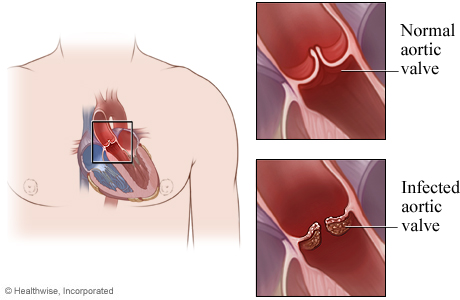 The heart with detail of a normal aortic valve and an infected aortic valve