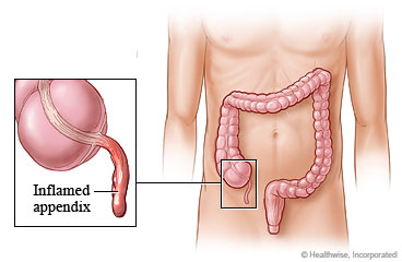 Inflamed appendix