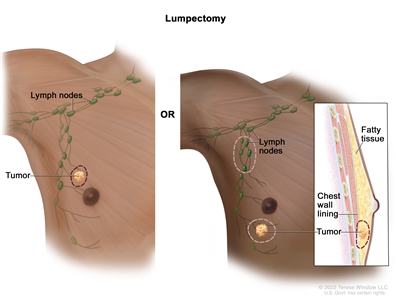 Lumpectomy; the drawing on the left shows removal of the tumor and some of the normal tissue around it. The drawing on the right shows removal of some of the lymph nodes under the arm and removal of the tumor and part of the chest wall lining near the tumor. Also shown is fatty tissue in the breast.