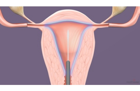 Endometrial Ablation