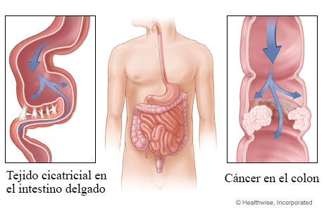 Obstrucciones en los intestinos delgado y grueso.