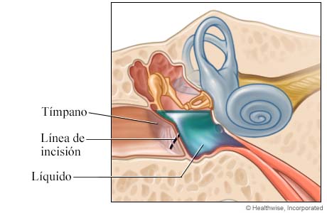 Una incisión hecha en el tímpano