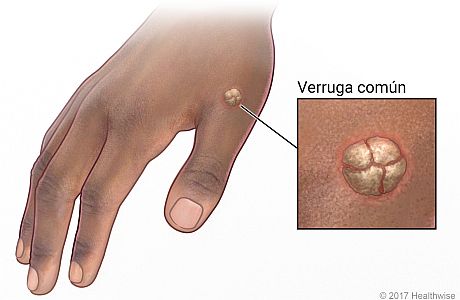 Verruga común en la mano, con primer plano de la verruga