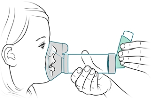 Cámara de inhalación con mascarilla bien ajustada sobre la boca y la nariz de un niño.