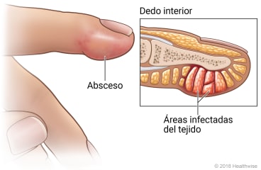 Panadizo en la yema del dedo, con detalle del interior del dedo mostrando zonas infectadas de tejido