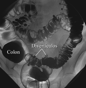 Diverticulosis