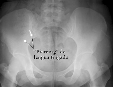 Imagen de un "piercing" de lengua tragado