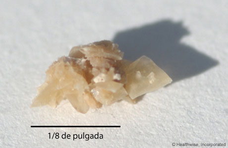 Cálculo renal (imagen ampliada)