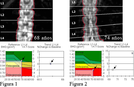 Densidad ósea de la columna vertebral