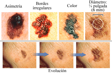 Los ABCDE del melanoma