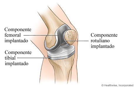 Artroplastia de rodilla finalizada