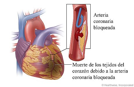 Daño al corazón causado por un ataque al corazón