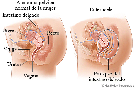 Prolapso del intestino delgado