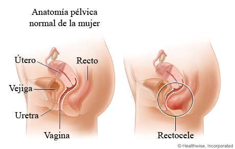 Rectocele