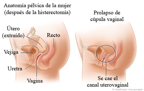 Prolapso de cúpula vaginal