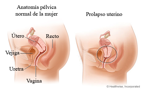 Prolapso uterino