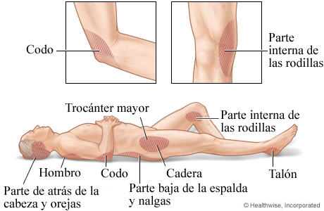 Zonas donde suelen formarse las lesiones por presión.