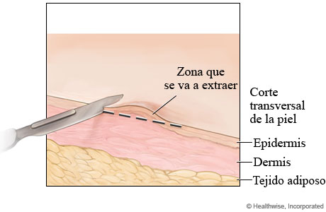 Biopsia cutánea por afeitado.