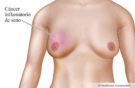 Cáncer inflamatorio de seno