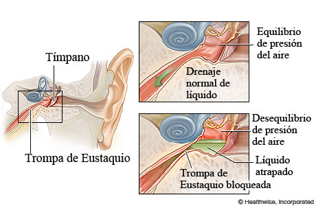 Trompas de Eustaquio normales y bloqueadas