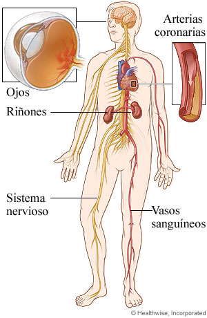 Zonas del cuerpo afectadas por la diabetes