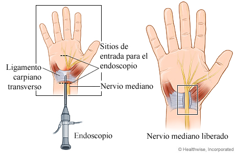 Cirugía endoscópica de liberación del túnel carpiano