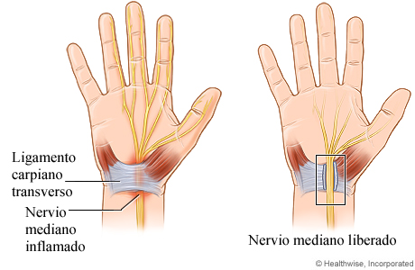 Cirugía abierta de liberación del túnel carpiano