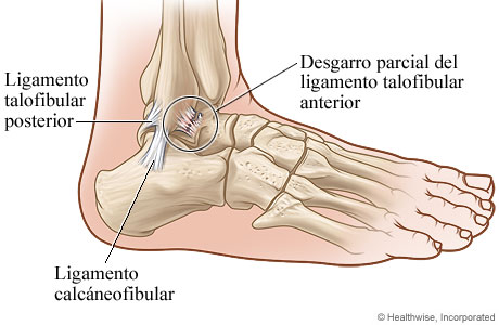 Tobillo con desgarro de ligamento