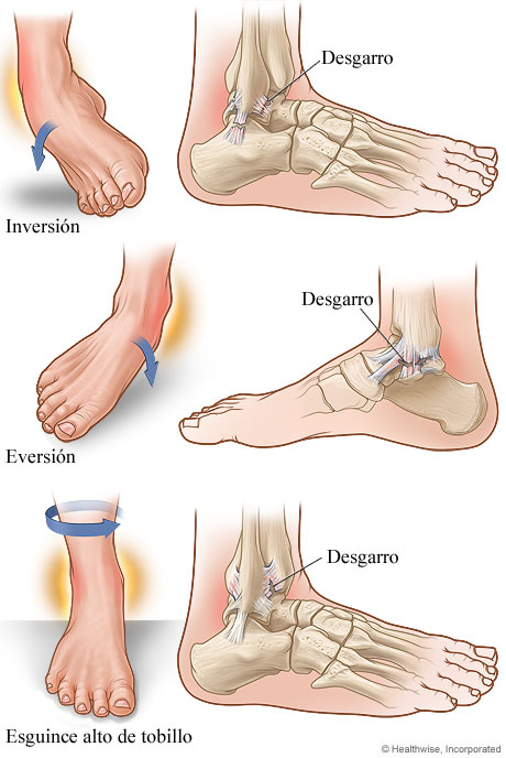 Tipos de esguince de tobillo