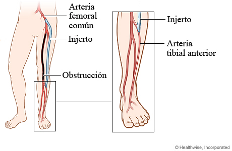 Arteria obstruida y posición del injerto en la cirugía de derivación femorotibial