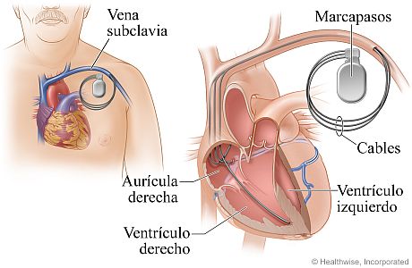 Ubicación del marcapasos y cómo está conectado al corazón