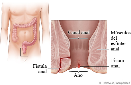 Imagen de fisura y fístula anales