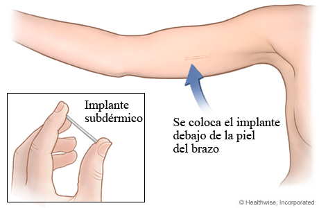 Implante subdérmico como método anticonceptivo.