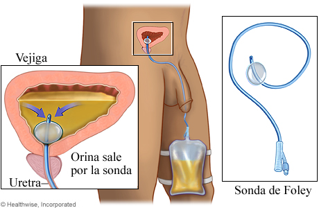 Sonda de Foley