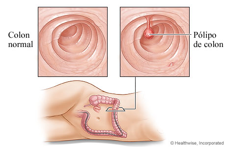 Un colon saludable y un pólipo de colon