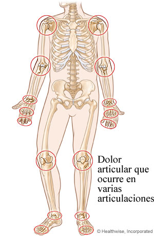 Imagen de los sitios comunes de la artritis reumatoide